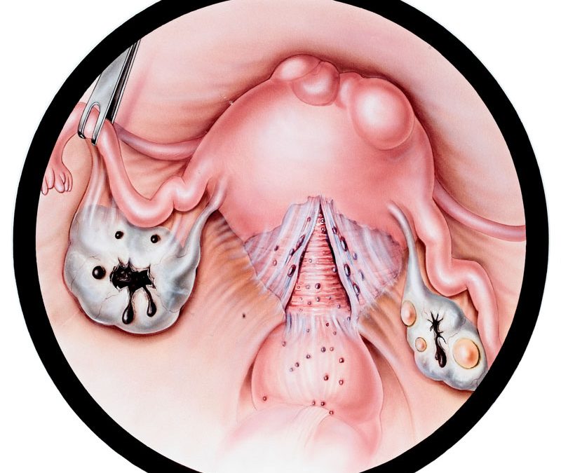 Endometriosis Studies